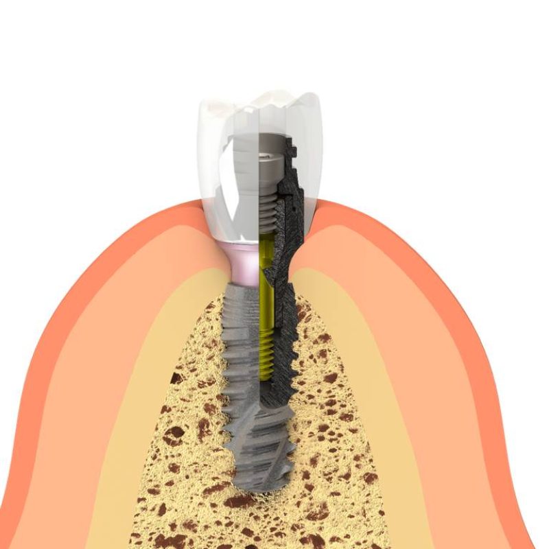 Dental Implant System photo