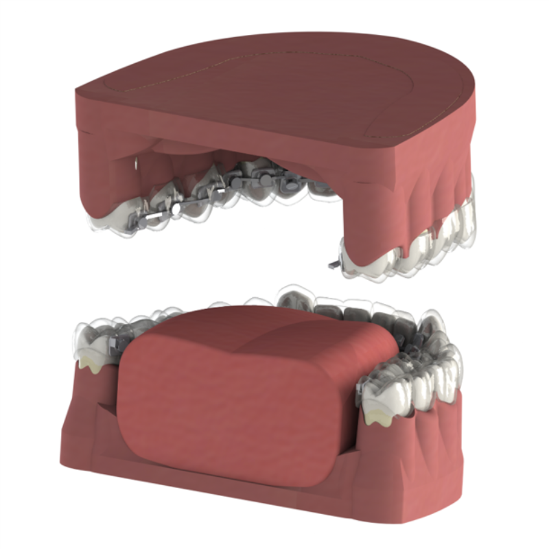 Mixed Lingual Orthodontic System photo