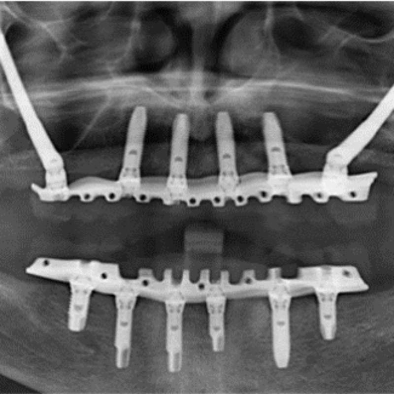 Zygomatic Implants photo